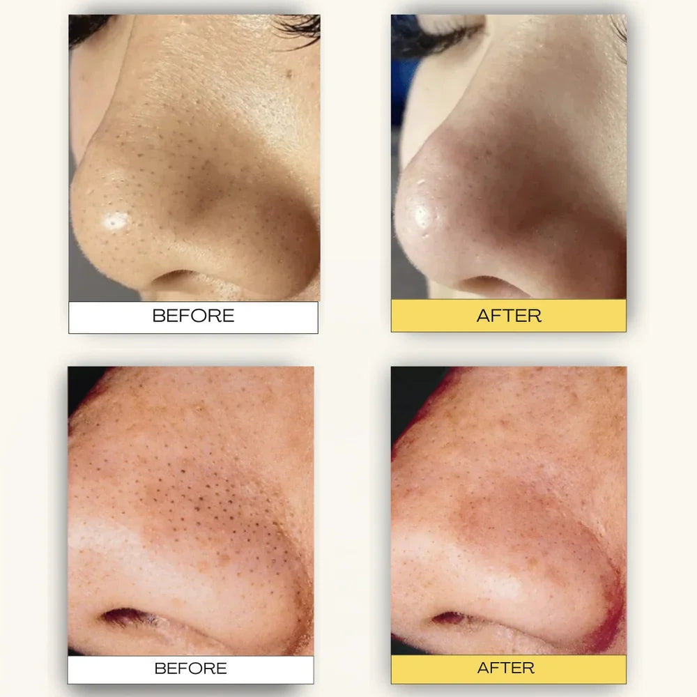 Deep Cleansing Patch System